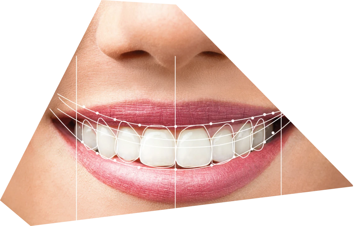 Smile Design